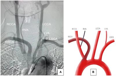 Case report: Right vertebral and carotid artery anomalies with an aberrant right subclavian artery in two patients